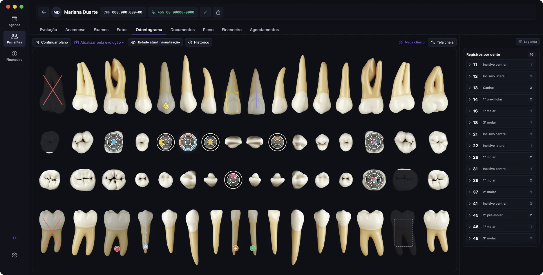 Tela real do odontograma do app no tema escuro: dentes renderizados individualmente com condições e procedimentos marcados, e registros por dente ao lado